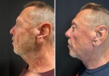 before and after neck lift NYC left side view male patient case 28671