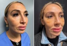 before and after rhinoplasty right angle view case 28891