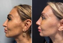 before and after rhinoplasty left side view case 28891