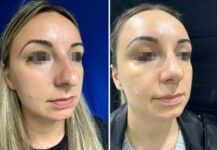 before and after rhinoplasty Murray Hill Plastic Surgery right angle view case 28912