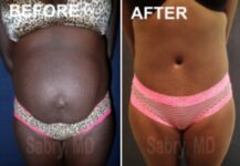 tummy tuck before and after female patient front view case 28506