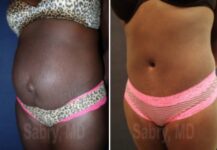 tummy tuck before and after female patient angle view case 28506
