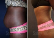 tummy tuck before and after female patient side view case 28506