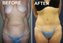 tummy tuck before and after female patient front view case 28510
