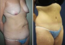 tummy tuck before and after female patient angle view case 28510