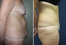 tummy tuck before and after female patient side view case 28510