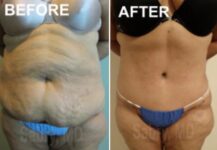 before and after a tummy tuck front view female patience case 28514