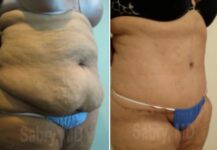 before and after a tummy tuck angle view female patience case 28514