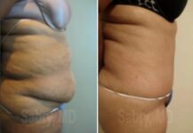 before and after a tummy tuck side view female patience case 28514