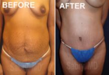 before and after a tummy tuck front view female patience case 28518