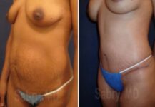 before and after a tummy tuck angle view female patience case 28518