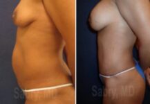before and after a tummy tuck side view female patience case 28518