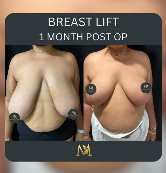 Before and after breast lift NYC 1 month post op