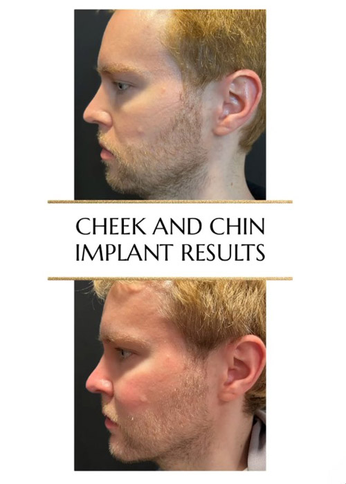 before and after cheek and chin implants NYC