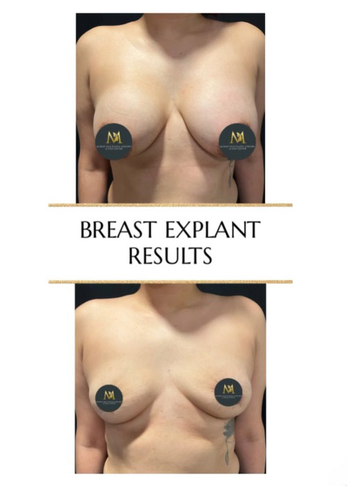 before and after breast explant surgery Dr. Sabry Murray Hill Plastic Surgery