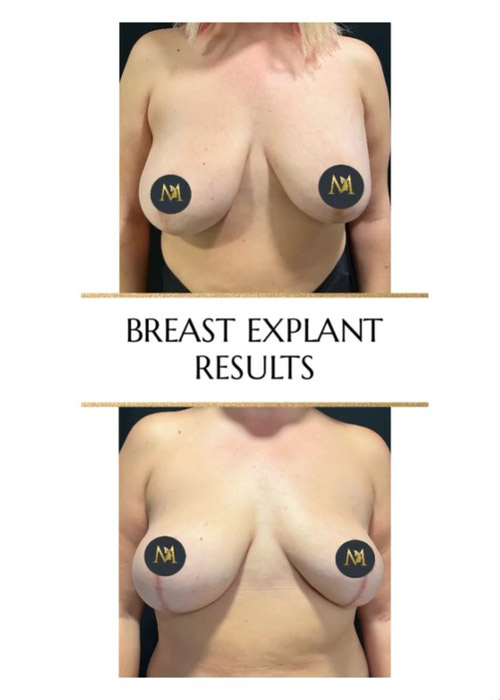 before and after breast explant NYC Murray Hill Plastic Surgery