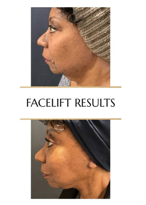 before and after facelift NYC at Murray Hill Plastic Surgery