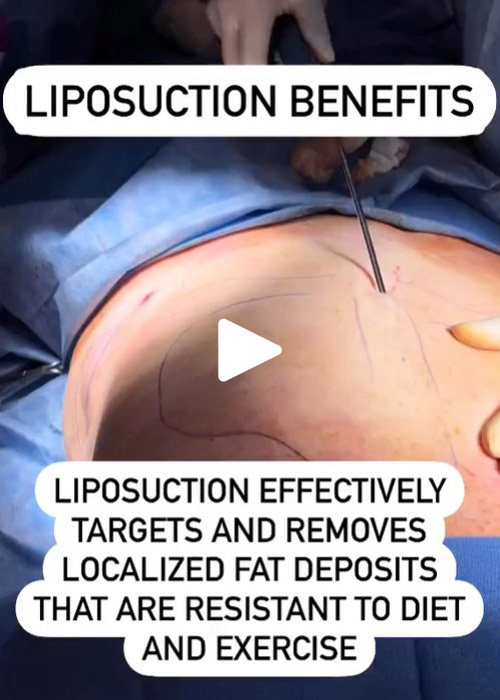 Liposuction benefits at Murray Hill Plastic Surgery NYC