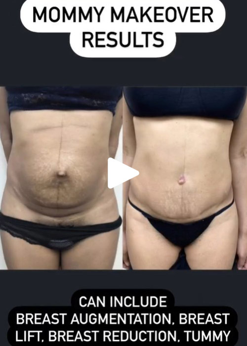 before and after mommy makeover results