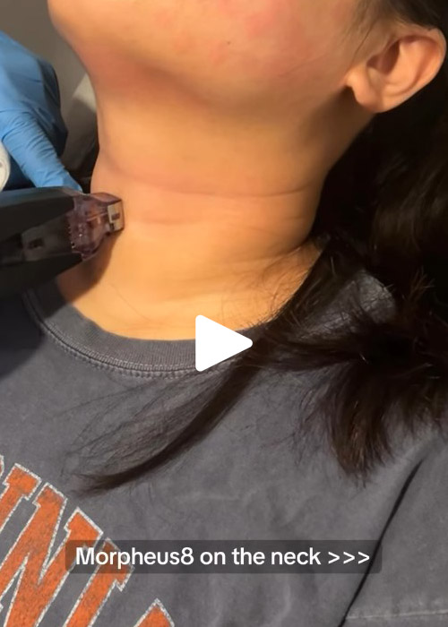 Morpheus8 results on the neck