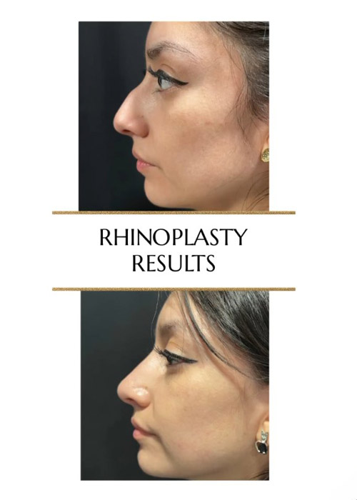 before and after rhinoplasty results Murray Hill Plastic Surgery