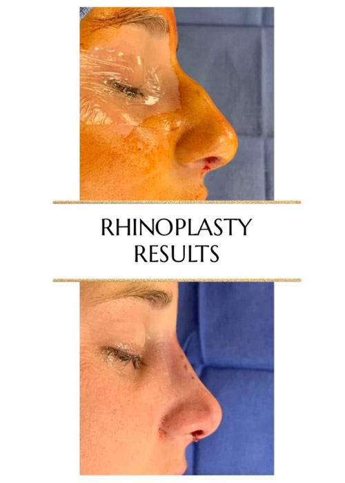 before and after rhinoplasty results Murray Hill Plastic Surgery NYC