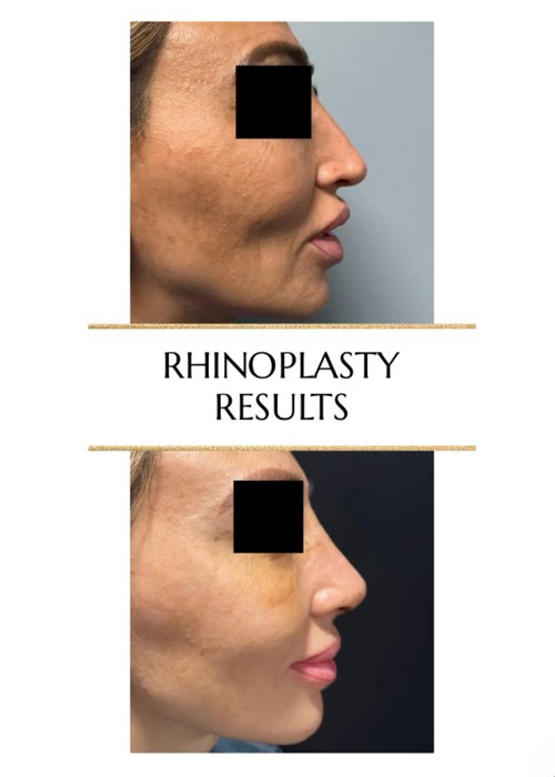 before and after female rhinoplasty results NYC Murray Hill Plastic Surgery