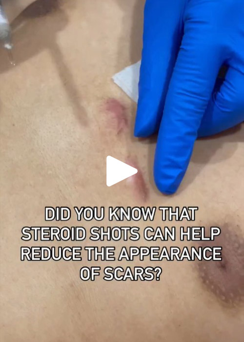 steroids reducing scars Murray Hill Plastic Surgery