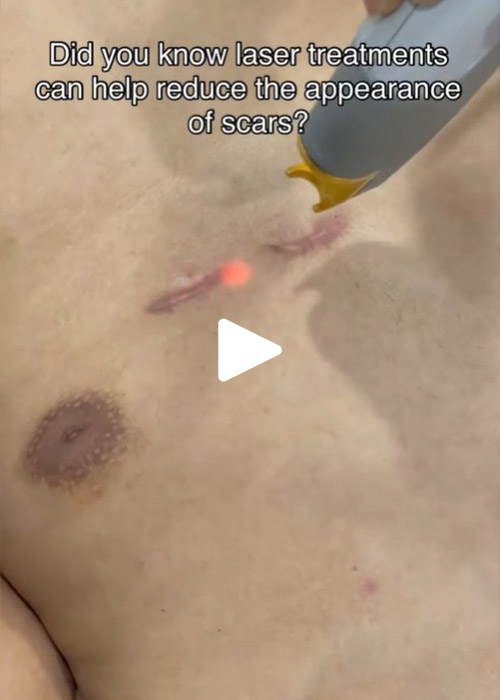 laser treatments reducing scar appearance Murray Hill Plastic Surgery