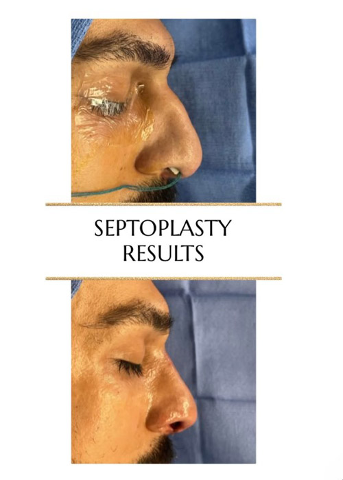 before and after male septorhinoplasty NYC