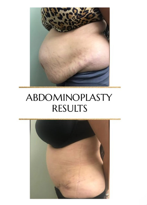 before and after tummy tuck female patient NYC