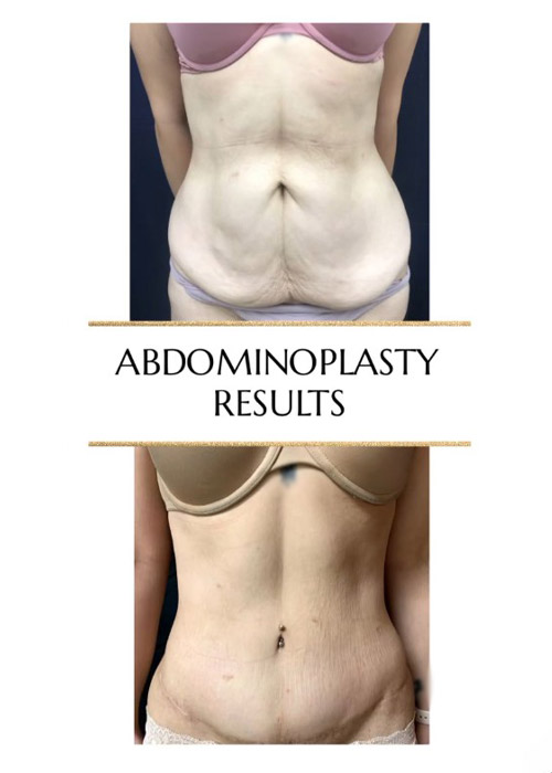 before and after tummy tuck after weight loss NYC