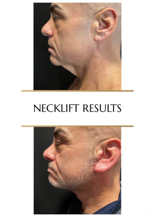 before and after necklift results NYC male patient