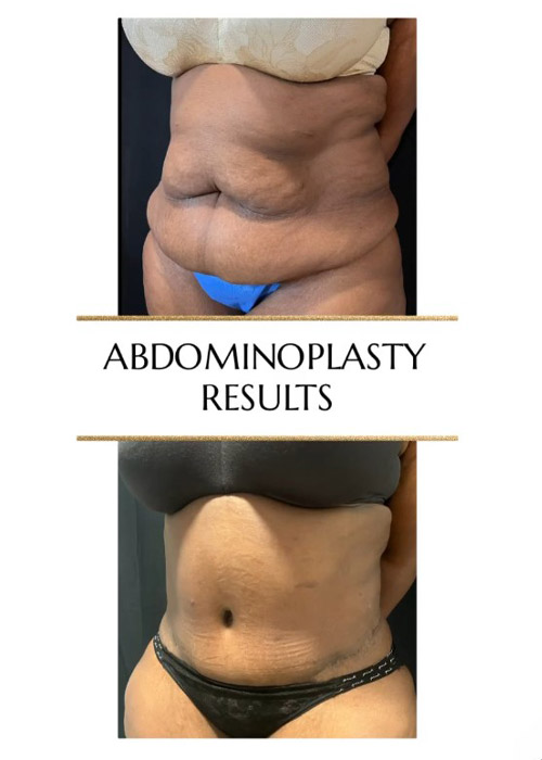 before and after female tummy tuck results Murray Hill Plastic Surgery