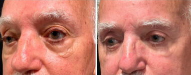 before and after male blepharoplasty Dr. Sabry left angle view case 30143