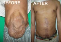 before and after male hernia correction front view case 30168
