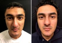 before and after male rhinoplasty NYC front view case 30156