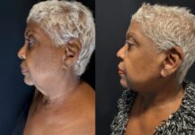 before and after necklift NYC female patient left side view case 31387