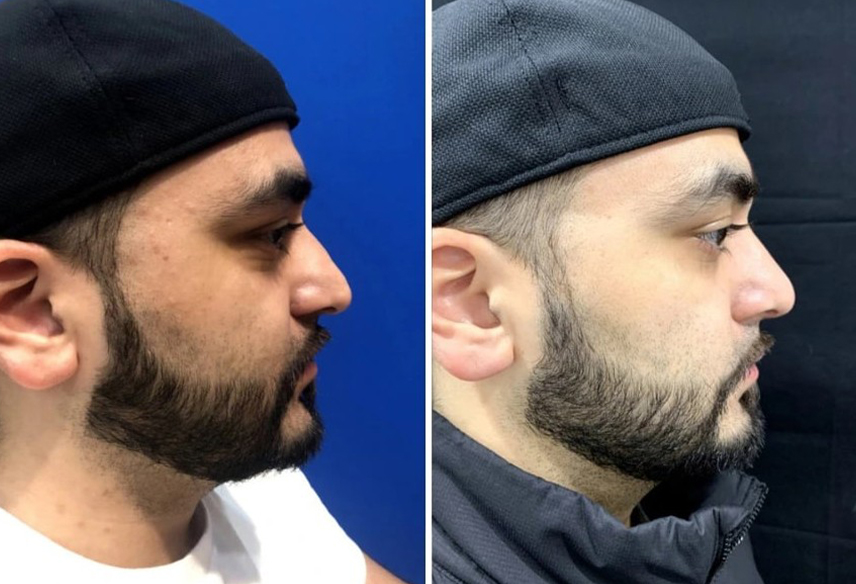 before and after septorhinoplasty NYC male patient