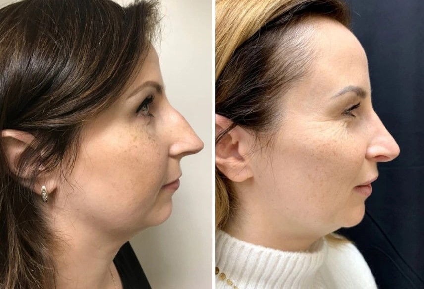 Before and after septorhinoplasty NYC female patient