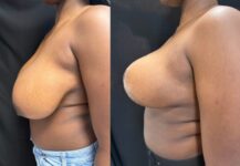 before and after breast reduction NYC left side view case 33471