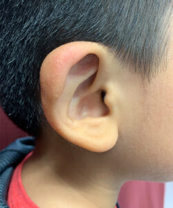 before ear shaping procedure NYC child patient right side case 33649