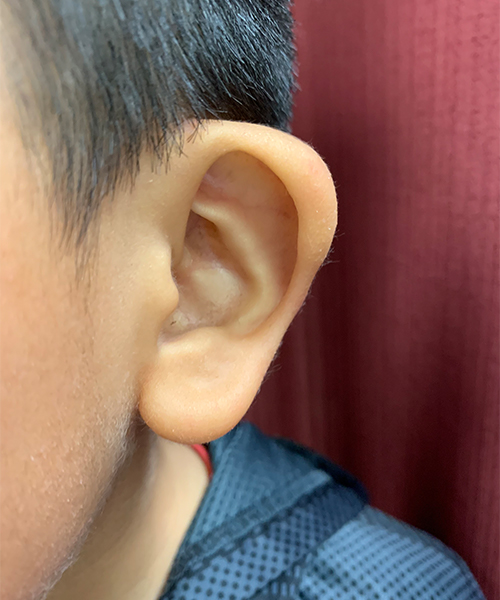 before ear shaping procedure NYC child patient left side view case 33649