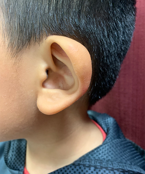 before ear shaping procedure NYC child patient left view case 33649