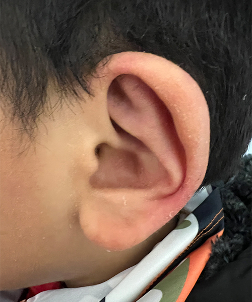 after ear shaping procedure NYC child patient left view case 33649
