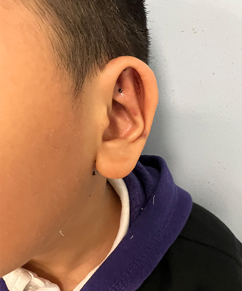 after ear shaping procedure NYC child patient left side view case 33649